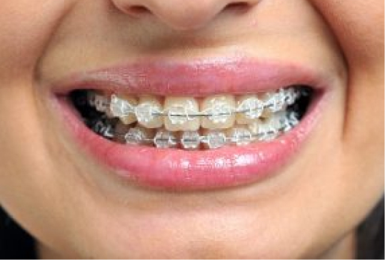 Metal Braces  Manchester Orthodontics