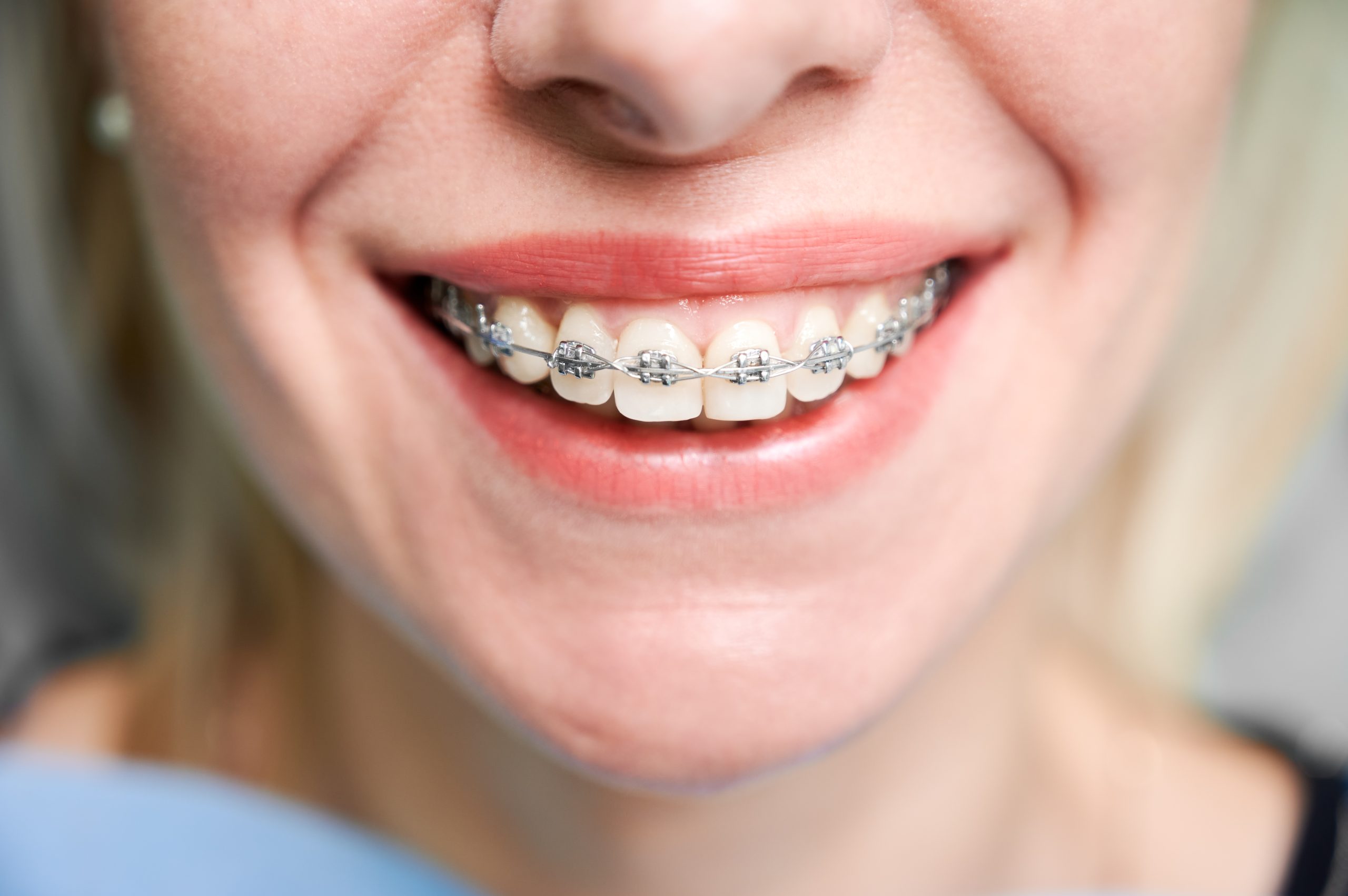 Metal braces London  Orthodontics in London